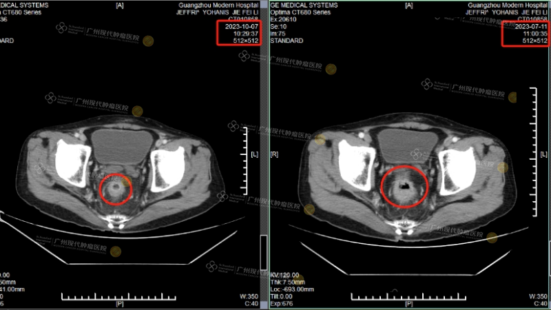 介入后直肠肿瘤前后对比.png